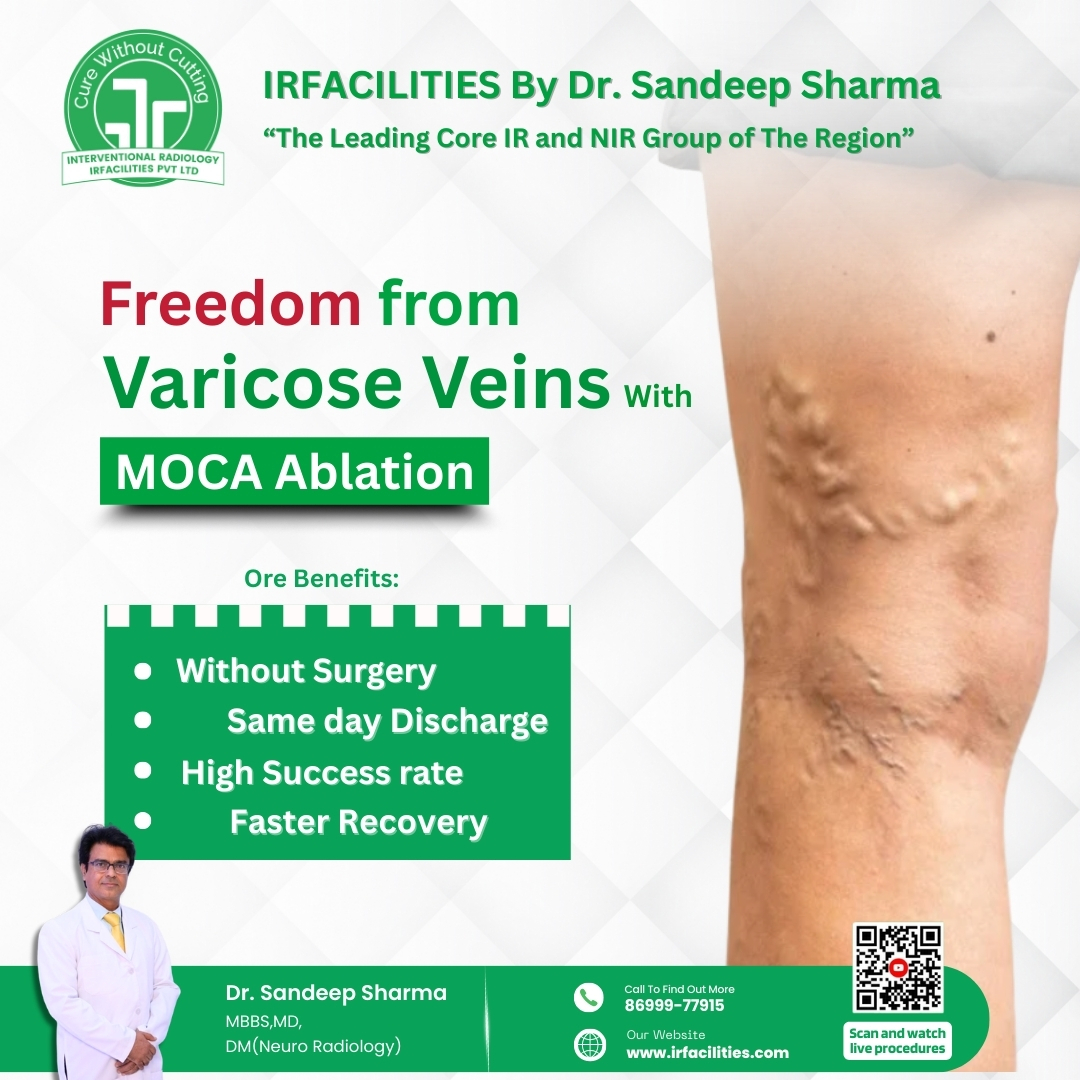Varicose Veins Treatment Cost