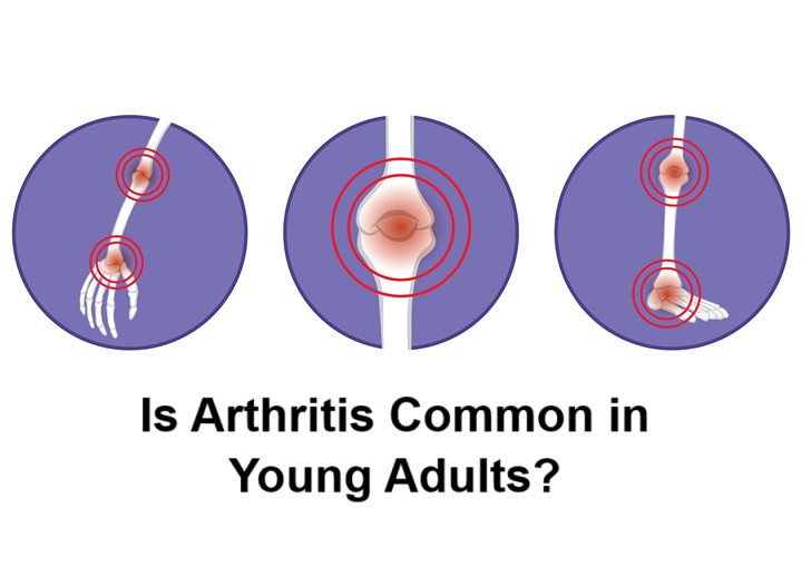 Is Arthritis Common in Young Adults?