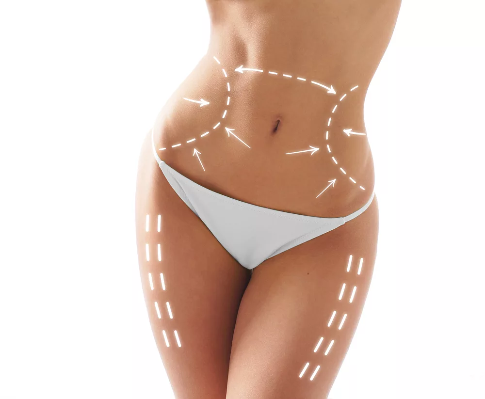 Liposuction in Islamabad