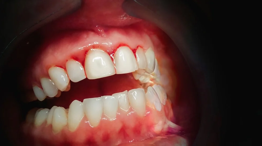 Deficiency Causes Bleeding Gums