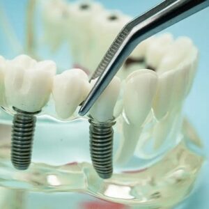 Dental implant treatment