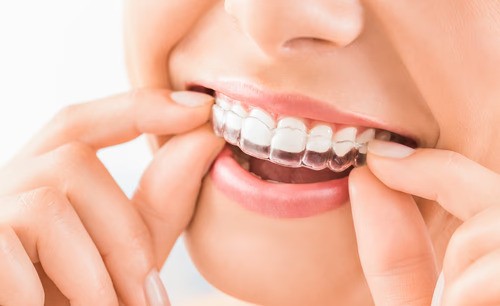teeth aligners in islamabad